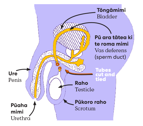 Vasectomy line drawing